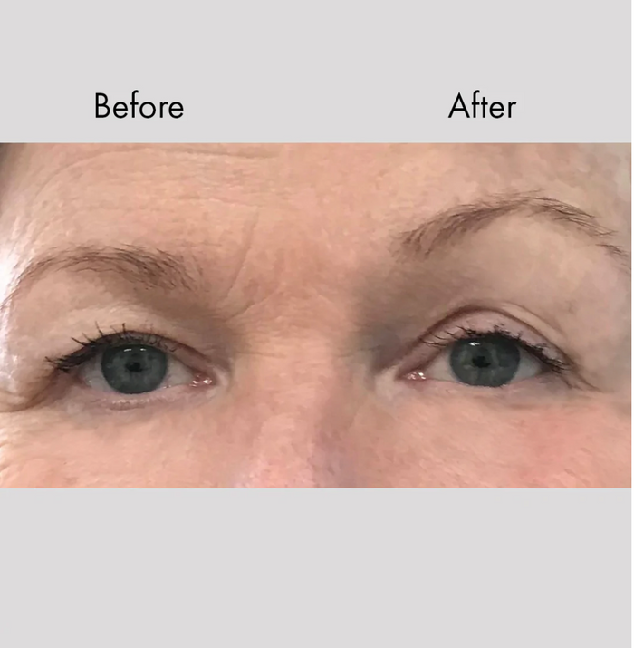 Instant Face & Brow Lift