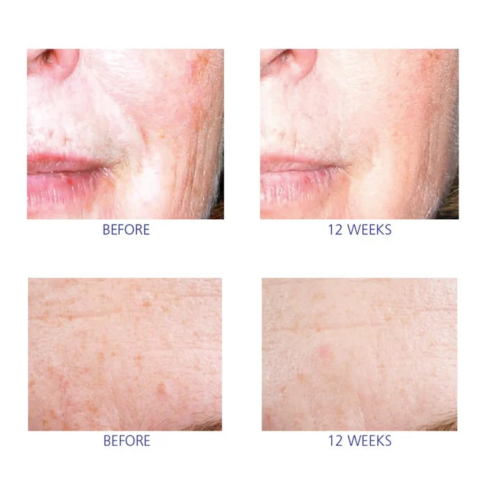 Close-up before and after photos showing skin texture and pigmentation changes over 12 weeks