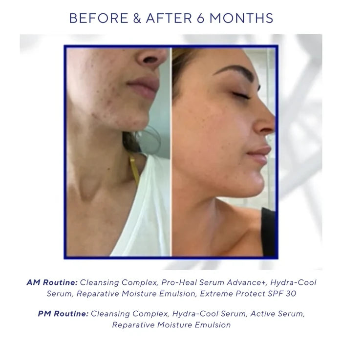 Side-by-side comparison of a woman's jawline and cheek before and after six months of skincare routine