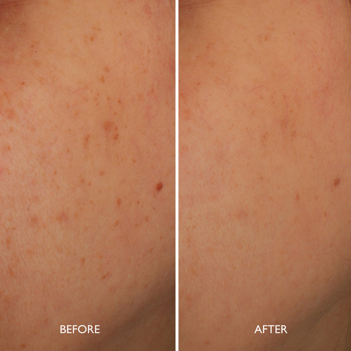 Age Benefit Hyperpigmentation Repair