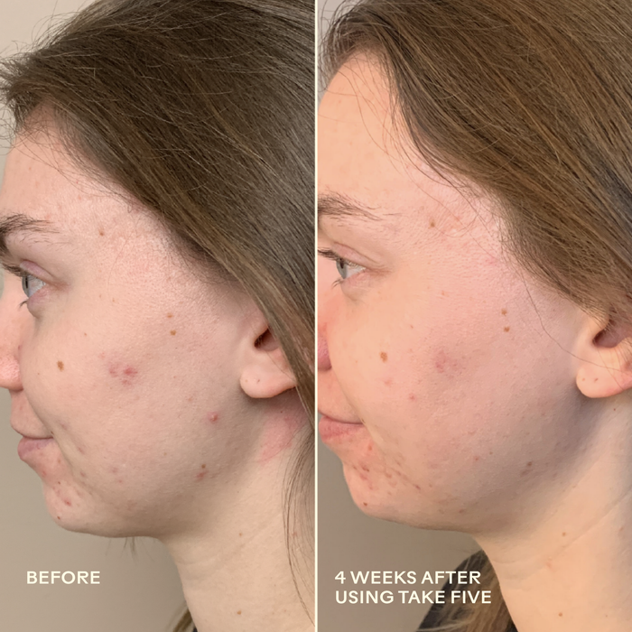 Three Ships-Take Five™ Hypochlorous Acid Balancing Body + Face Spray-Skincare-990478500341_8_Before_After-The Detox Market |
