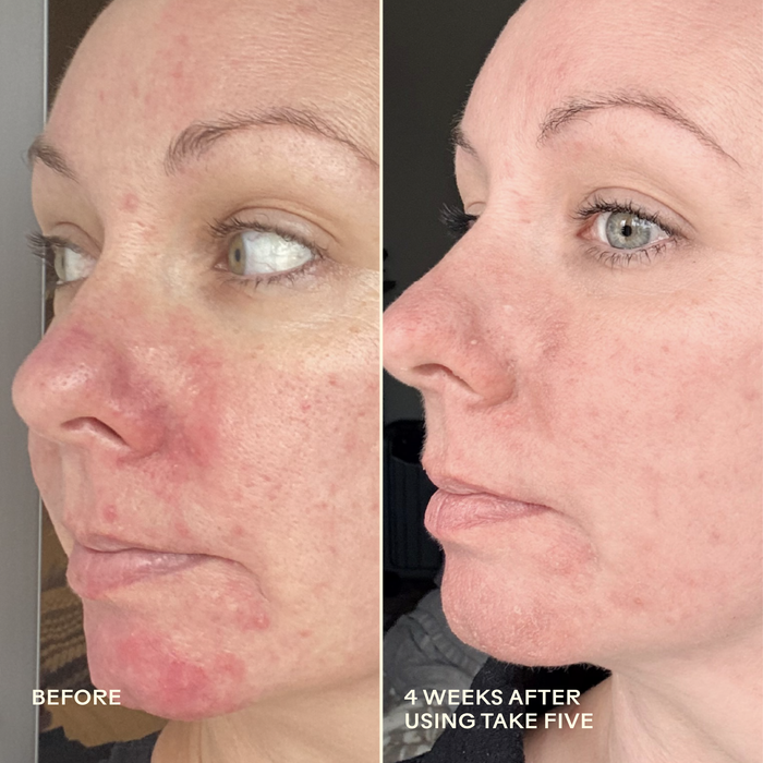 Three Ships-Take Five™ Hypochlorous Acid Balancing Body + Face Spray-Skincare-990478500341_7_Before_After-The Detox Market |
