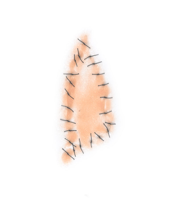 Triangular Shaped Sutured Wound
